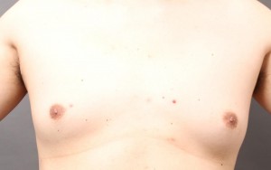 女性化乳房 傷跡
