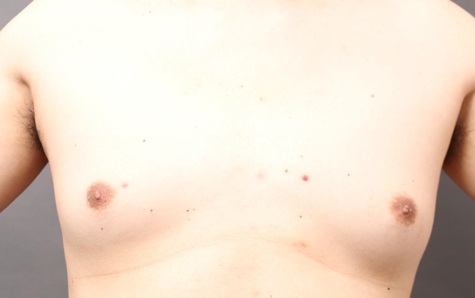 女性化乳房：乳腺切除も最小限の傷跡で
