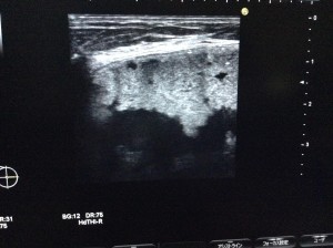 他院脂肪注入後しこり除去 crf豊胸