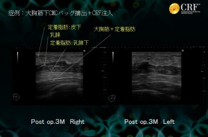 バッグ抜去 crf豊胸