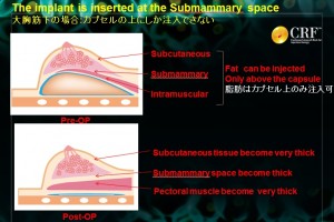 バッグ抜去 crf豊胸