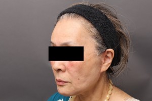 フェイスリフト