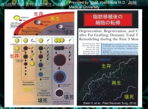 脂肪注入豊胸の基礎知識