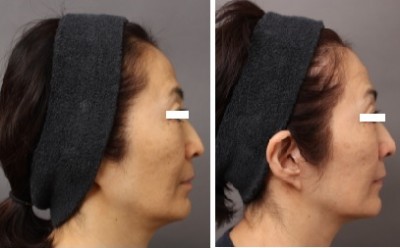 フェイスリフト手術8か月後