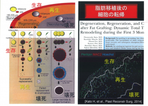 脂肪注入豊胸の最新情報