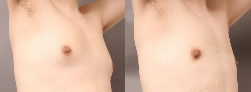 女性化乳房:VASERとサーミタイトで胸を平らに