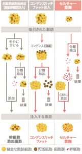 脂肪注入豊胸の種類