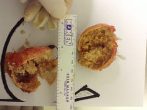 脂肪注入後しこり除去