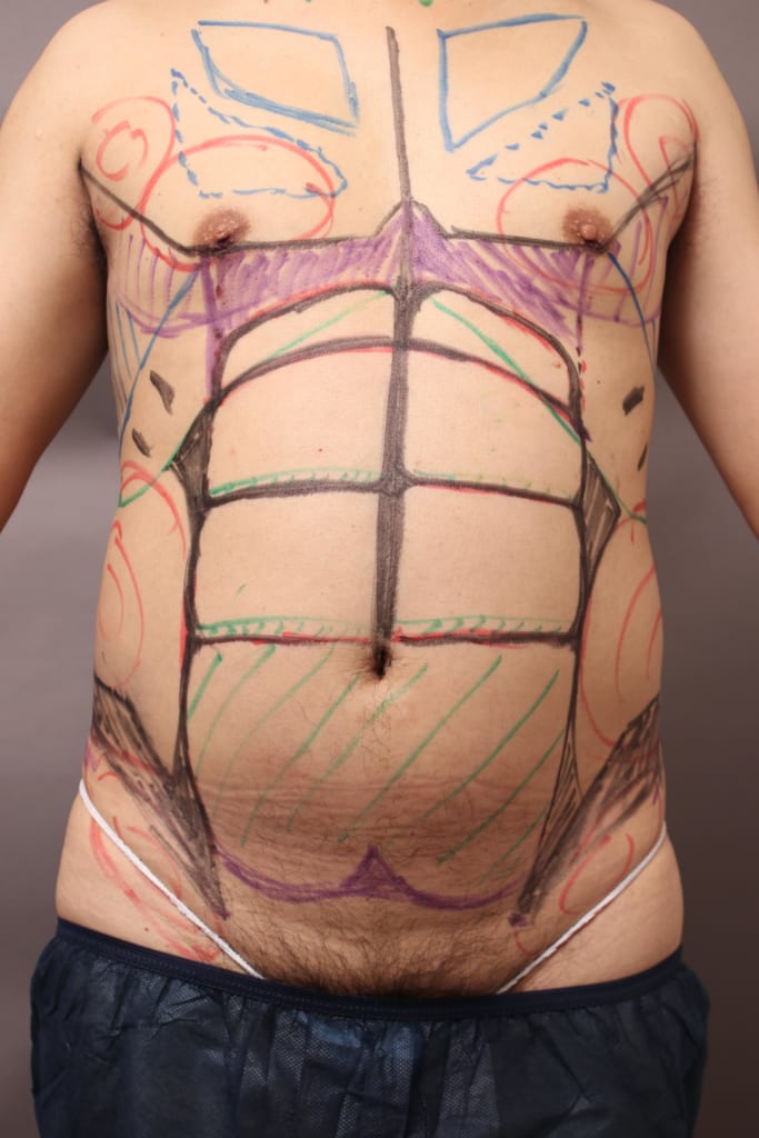 本日のベイザー4D：腹筋シックスパック＋胸部のデザイン（大胸筋増強）