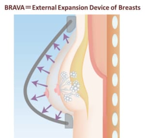 brava併用crf豊胸