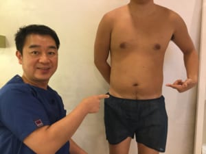 男性の脂肪吸引 シックスパック