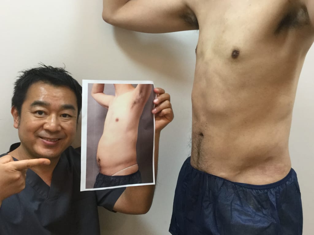 男性のベイザー脂肪吸引 たった1か月でこの結果 同じ人のお腹には見えません 大橋昌敬の脂肪吸引ブログ