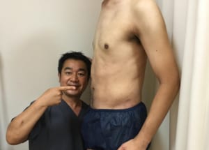 脂肪吸引 腹部