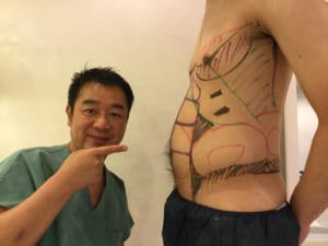 脂肪吸引 腹部