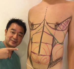 脂肪吸引 腹部