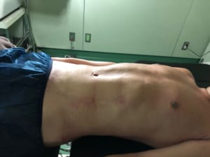 脂肪吸引 腹部