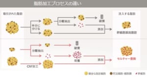 コンデンスリッチ豊胸とセリューション豊胸の違い