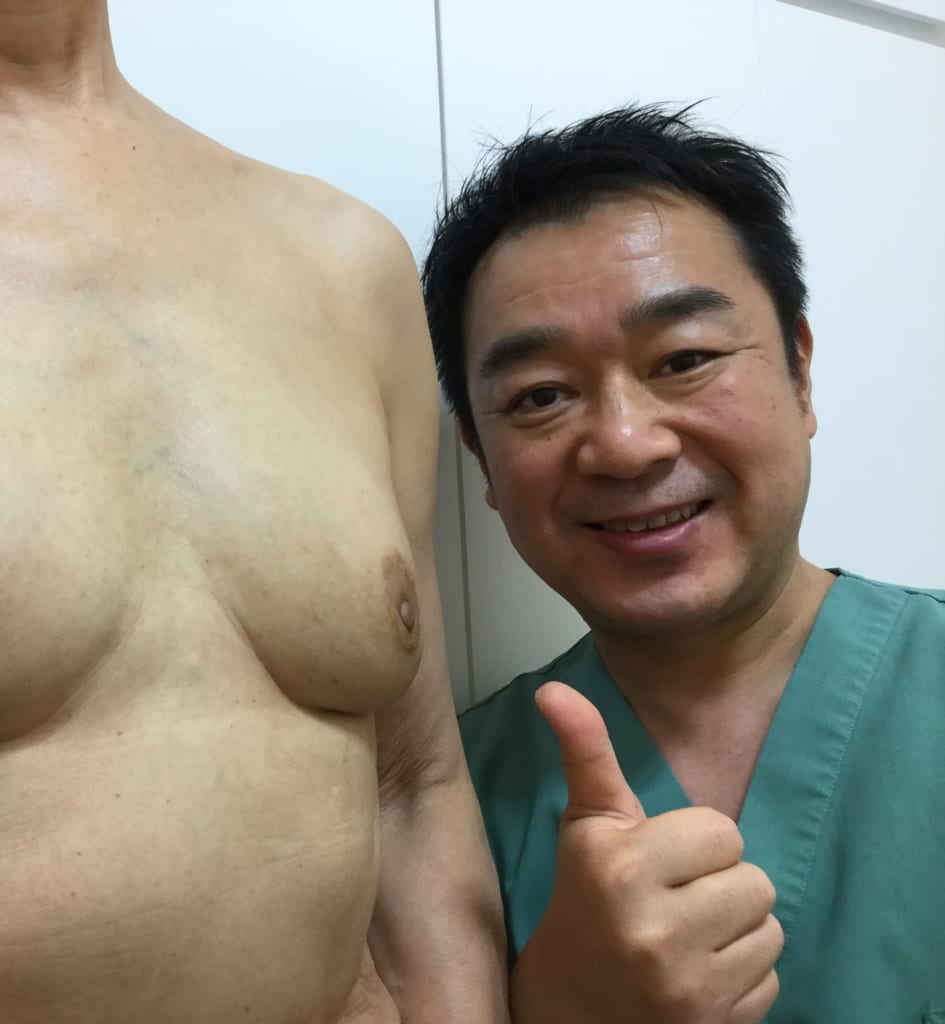 75歳とは思えない綺麗なバスト:バッグ取り出しと同時のCRF豊胸:長年の悩みから解放:自然な胸に感激