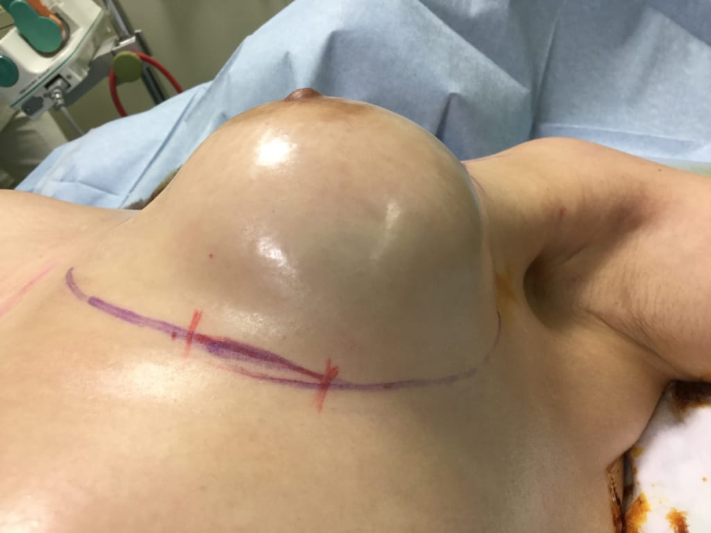 乳がん術後、放射線治療後石灰化したシリコンバッグ（乳房インプラント）抜去と同時のCRF豊胸