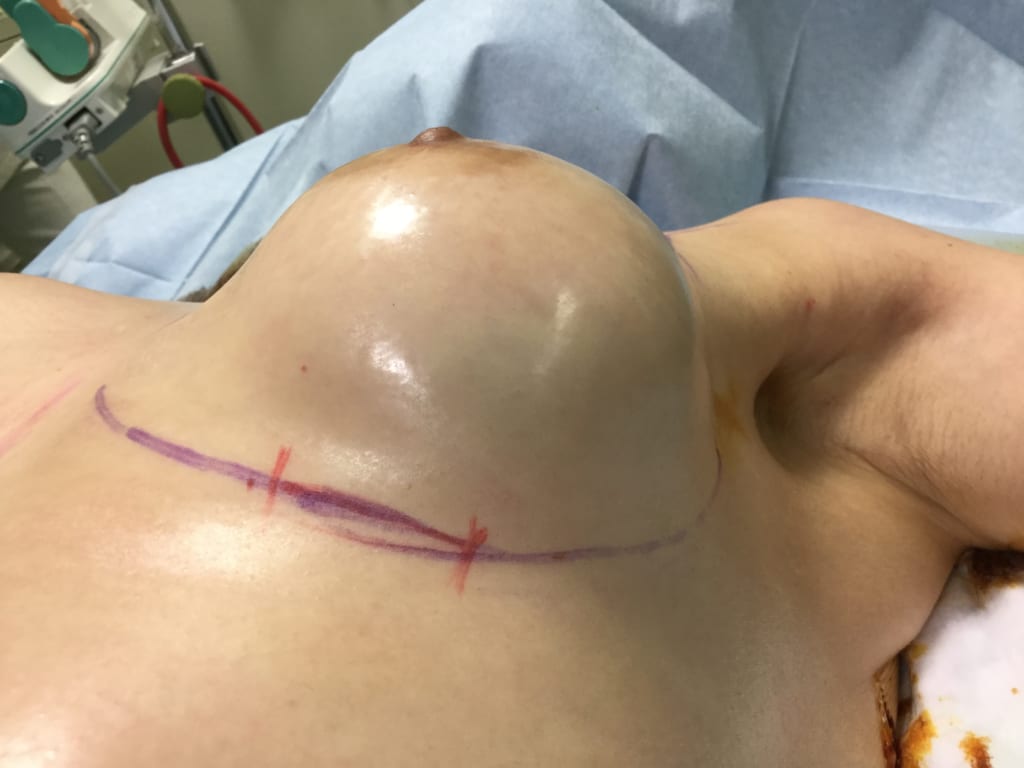 乳がん術後、放射線治療後石灰化したシリコンバッグ(乳房インプラント)抜去と同時のCRF豊胸