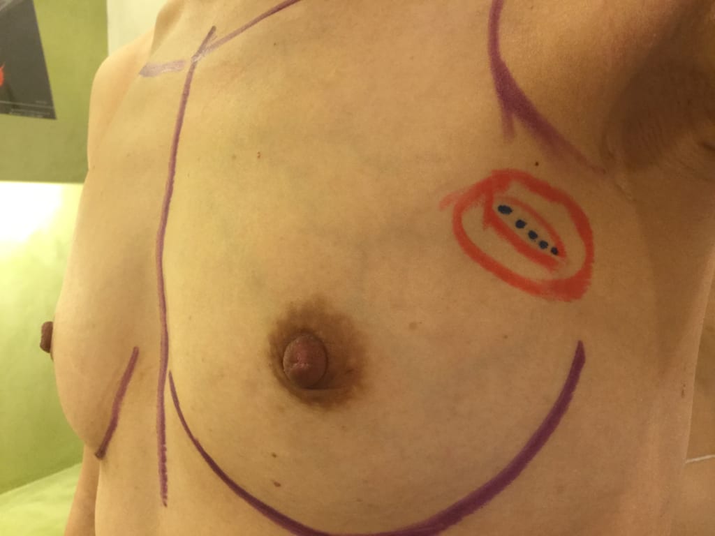 CRF豊胸と同時に以前の乳がん術後の凹みを改善