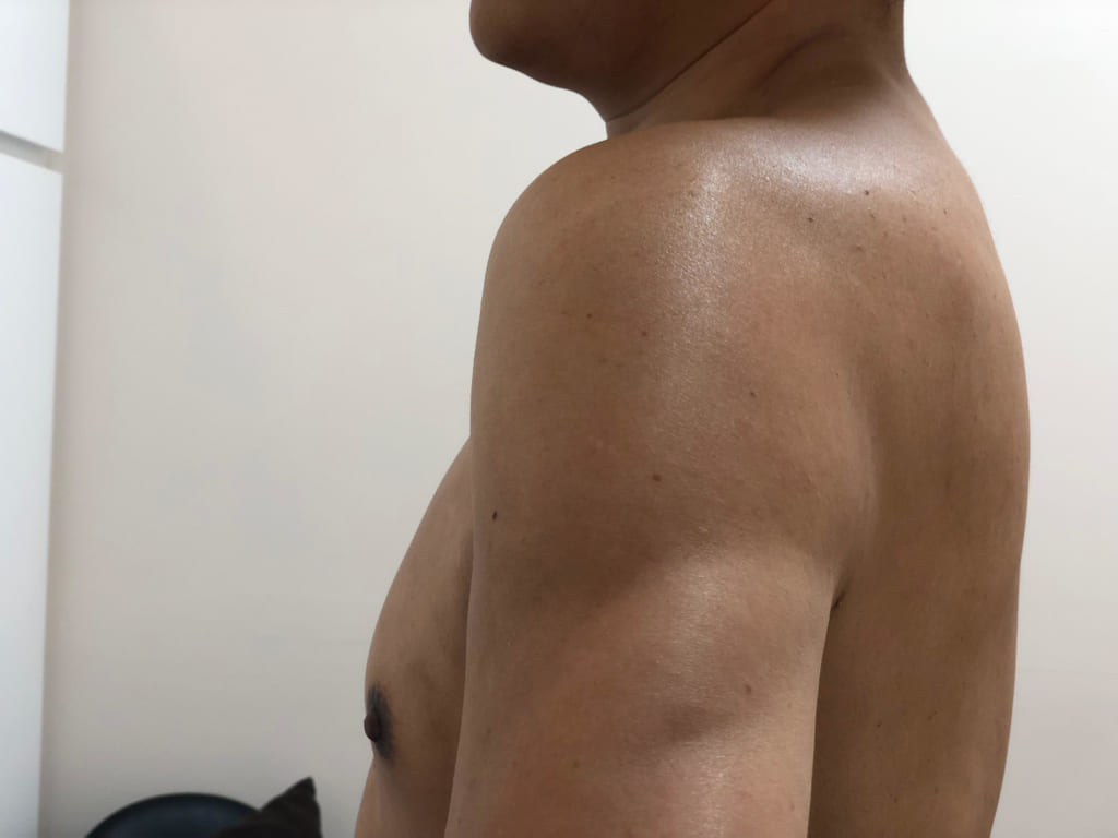 48歳男性:VASER4D術後1年:明らかに若々しい肉体ですね!