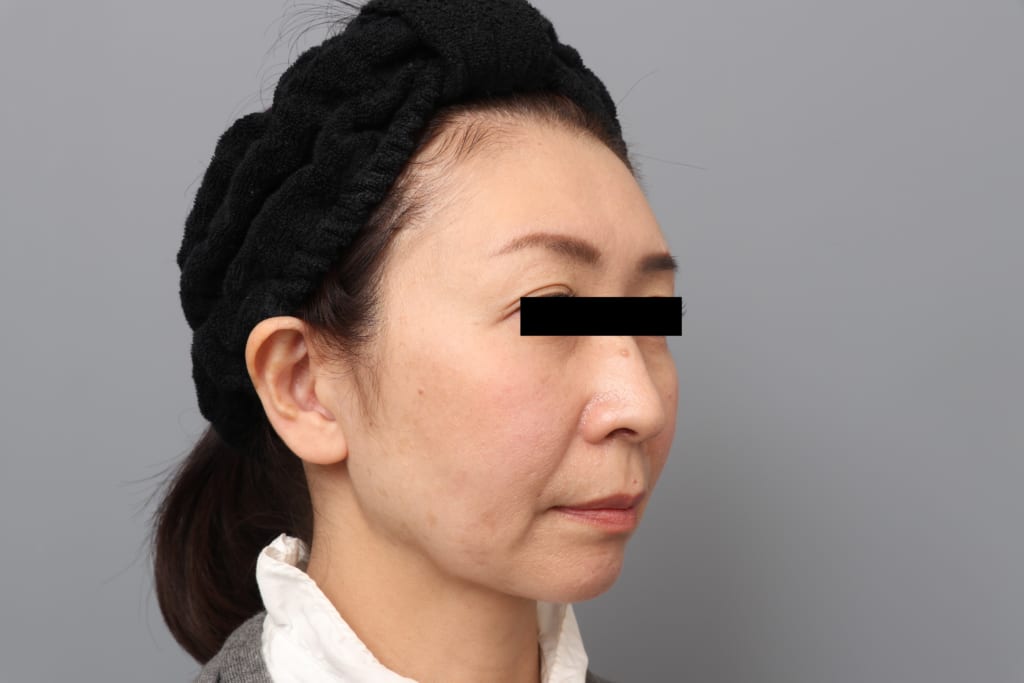 SRFフェイス:若さのキープ力がすごい。FATBANKでいつまでも若々しく!