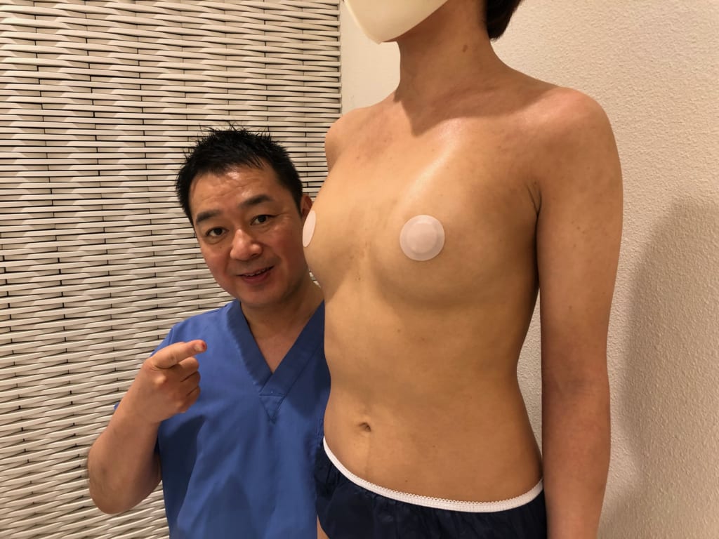 コンデンスビブラ豊胸(皮膚拡張器併用CRF豊胸)術後6M フラットなバストが形の良い柔らかいバストに