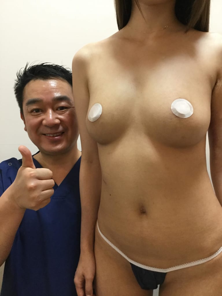 脂肪注入豊胸をした女性