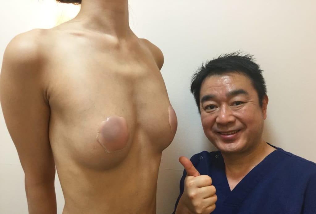 超やせ型:ビブラセルチャー豊胸術後3か月:ガリガリのバストが豊満なバストに