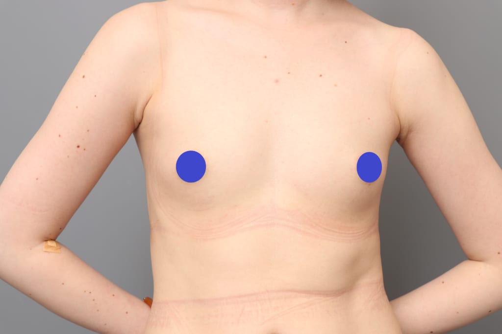 新手術：アンダーブーブ豊胸 フラットなバストの下乳をボリュームアップ
