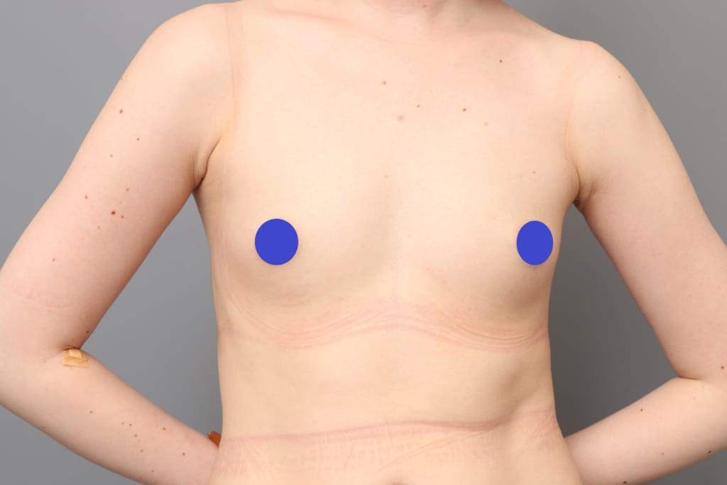新手術:アンダーブーブ豊胸 フラットなバストの下乳をボリュームアップ