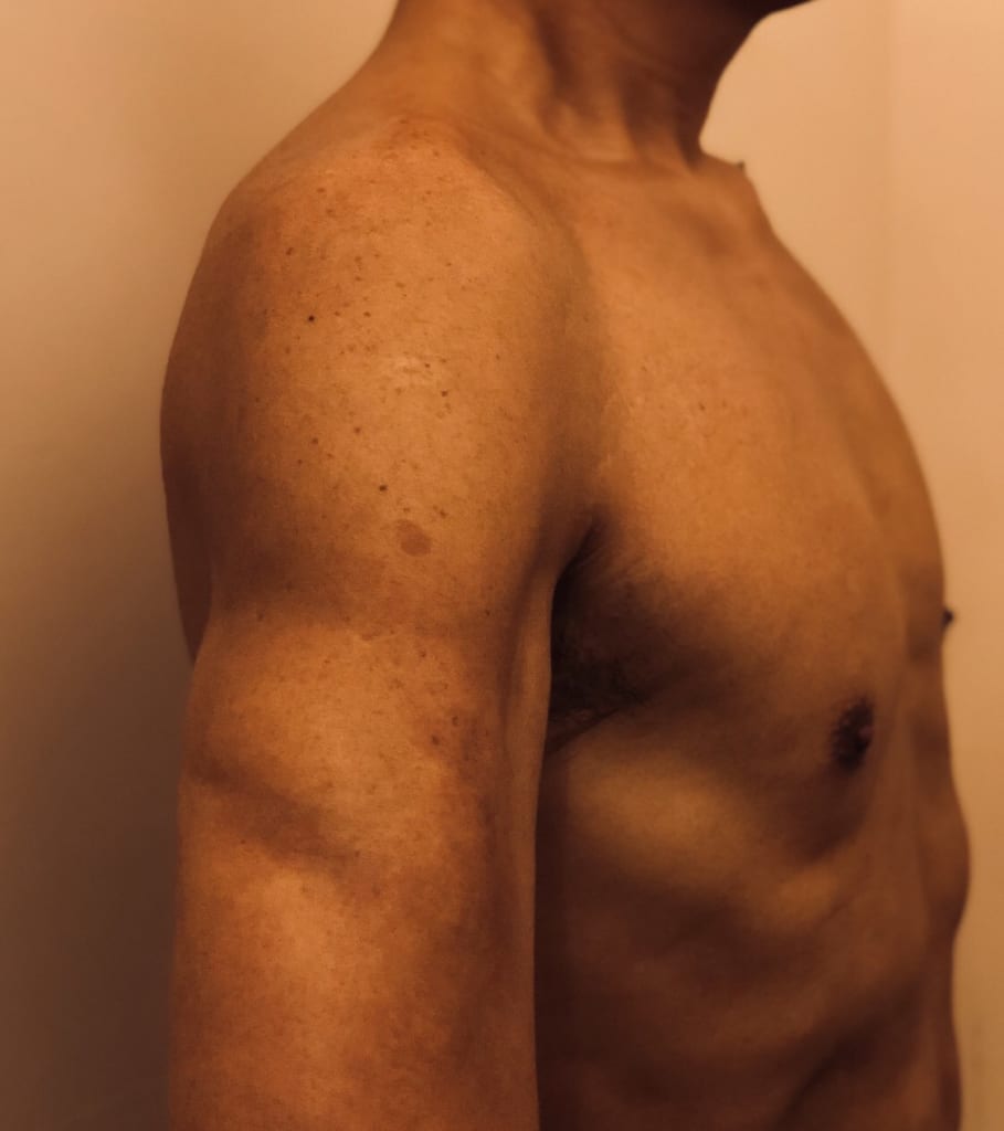 男性VASER4Dシックスパック術後6か月:お腹だけではなく上腕もくっきり