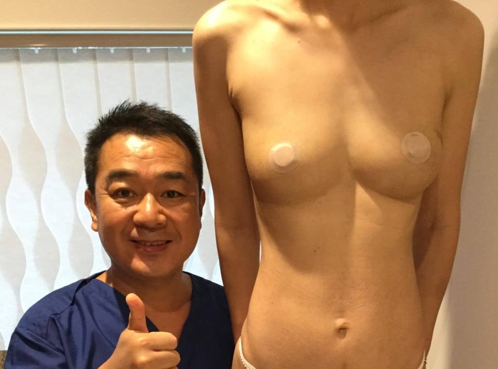 片側漏斗胸:ビブラ併用CRF豊胸で改善 術後6か月