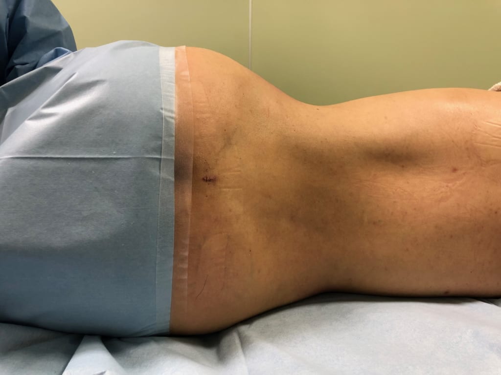 女性のベイザー4Dリポ:痩せていても脂肪は嫌い:クビレと健康的にお腹を割りたい