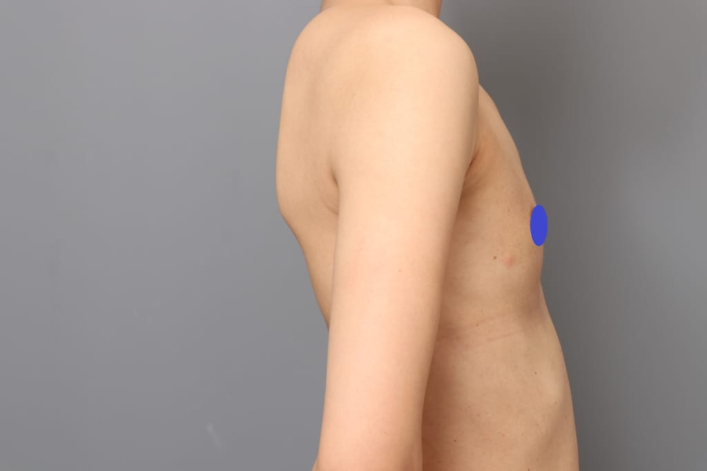 脂肪豊胸で大きくならないタイプ:ビブラ豊胸でその弱みを改善