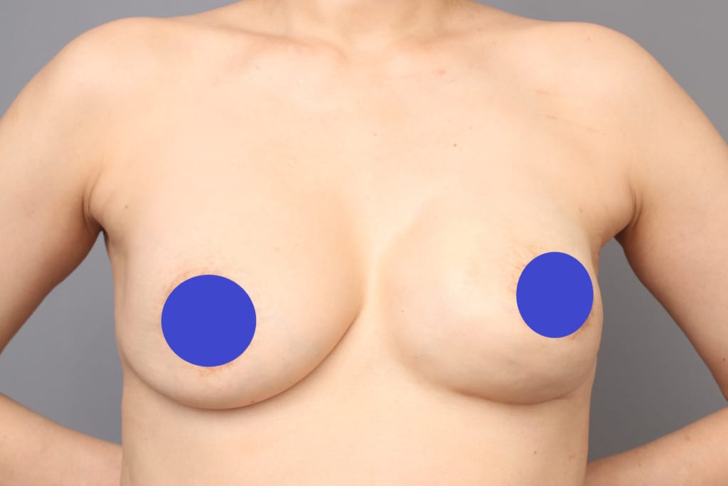 インプラントでの乳房再建済みバストを柔らかく、温かい自然なバストへ