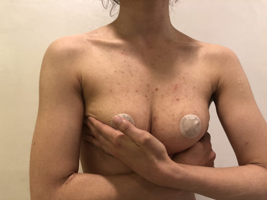 ビブラ×セルチャー×アンダーブーブ豊胸後 術後半年:生まれて初めて谷間が出来ました