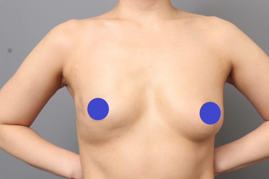 乳がん術後再建:エキスパンダー抜去+脂肪注入:異物を使わず乳房再建