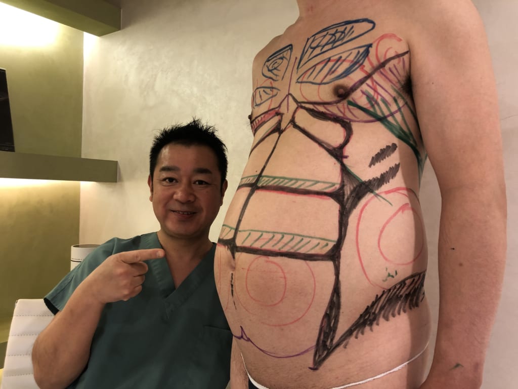 VASER4Dシックスパック:ぽっこりお腹が一か月ですっきり。ご本人のマインドにも変化が!