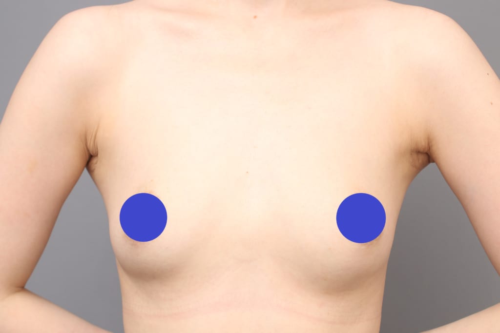 下乳がはっきりしない小ぶりなバスト、アンダーブーブ豊胸で乳房の下縁をクッキリさせつつ大きく