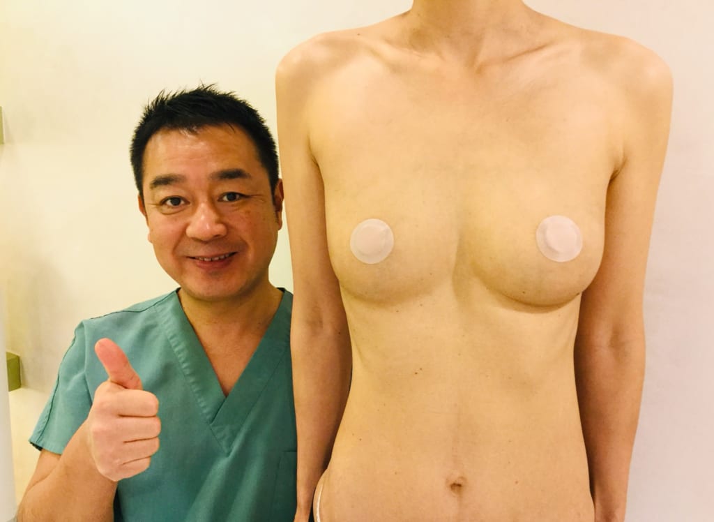 授乳後しぼんだバスト。漏斗胸もありデコルテがさみしく:ビブラ豊胸で大満足
