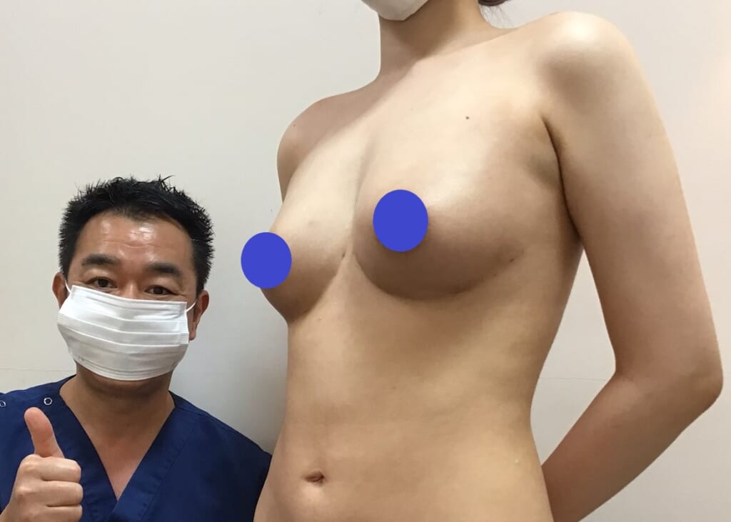 アンダーブーブ豊胸:糸の挿入手術で綺麗な形のバストに変化