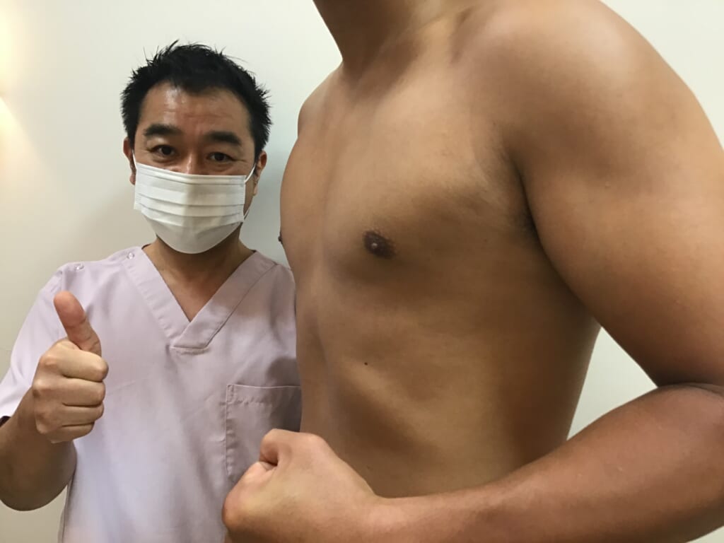 女性化乳房:乳腺切除+ベイザー+パワーX併用の吸引ですっきり:たくましい胸板