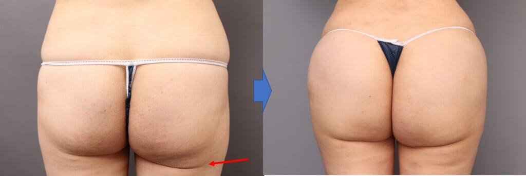 ブラジリアンヒップにしたい! 他院修正:臀部と太もも吸引後の下垂修正:レヌビオンと脂肪注入併用
