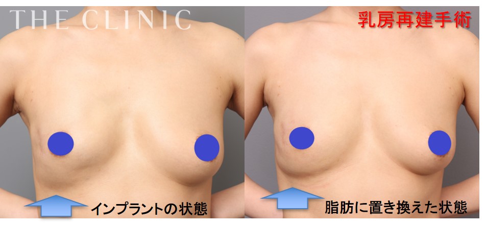 乳房再建：インプラントを摘出して、温かく柔らかい胸へ。摘出側のバストに汗をかくようにになったと嬉しいコメント。