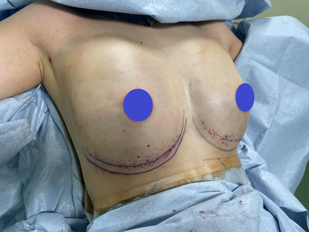 皮膚が伸びない小さな胸に朗報：ビブラに加え、リゴトミーで綺麗なバストへ