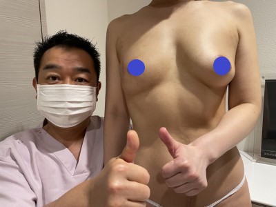 患側の乳房再建+健側豊胸 最終術後3か月